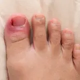 En inflammerad stortå med rodnad och svullnad runt nageln, vilket indikerar behov av nageltrång behandling.