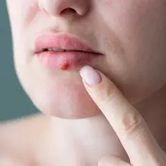 En person pekar på ett sår på läppen, troligen munherpes inne i munnen.
