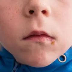 Närbild på ett barns mun med svinkoppor på hakan.