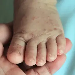 Ett litet barns fot med skabb utslag och torr hud, hålls i en vuxens hand.