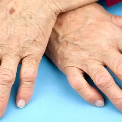 Äldre händer med synliga åderbråck och pigmentfläckar, som kan indikera behov av ny medicin mot reumatism.