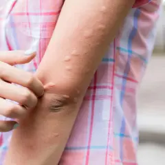 En arm med utslag som kliar, troligen från insektsbett. Utslagen är röda och upphöjda på huden.