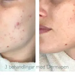 Före och efter-bilder visar hur Dermapen behandlat acneärr och förbättrat hudens textur.