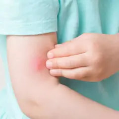 Barnets arm med ett rött, svullet myggbett. Barnet verkar vara allergisk mot myggbett och kliar på bettet.