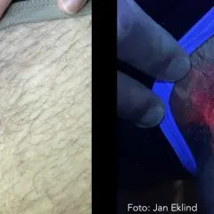 Hudutslag på ljumsken, synligt i vanligt ljus och under UV-ljus som visar en rödaktig svamp pung.