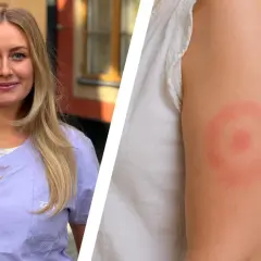 En kvinna med blont hår visar upp ett utslag på armen, ett tydligt tecken på borrelia.