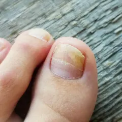 Tånagel med gulaktig missfärgning och förtjockning, tecken på nagelsvamp. Läs mer på 1177.