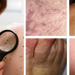 Hudförändringar som kan vara covid utslag. En person undersöker födelsemärken med förstoringsglas.
