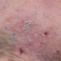 Hud med aktinisk keratos, rodnande, fjällande fläckar och sår. Synliga blodkärl.