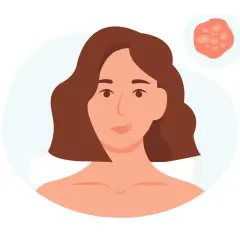 Illustration av en kvinna med en blåsa på läppen, som kan likna herpes. En närbild av blåsor visas i en cirkel.