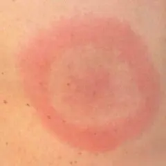 Rött, cirkulärt utslag på huden, liknande ett utslag i ansiktet som kan uppstå vid exempelvis borrelia.