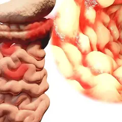 Illustration av inflammerade tarmar, som visar symtom på crohns sjukdom. En inre vy av tarmen visar rodnad och svullnad.