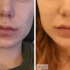 Före och efterbilder visar en minskning av akne och postinflammatorisk hyperpigmentering runt munnen.
