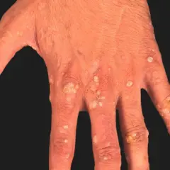 Hand med utslag av epidermodysplasia verruciformis. Många små, ljusa och mörkare fläckar samt knottror på fingrar och handrygg.