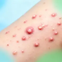 Närbild på hud med flera inflammerade finnar och pustler, vilket indikerar akne på ryggen.
