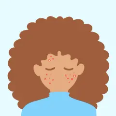 En illustration av en person med lockigt brunt hår och en blå tröja. Ansiktet har flera röda prickar, vilket indikerar finne under huden.
