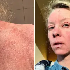 Bilden visar en person med svår hudirritation, fjällande hud på nacken och axlarna, samt rodnad och sår på ansiktet. Detta kan vara relaterat till användning av kortison och alkohol.