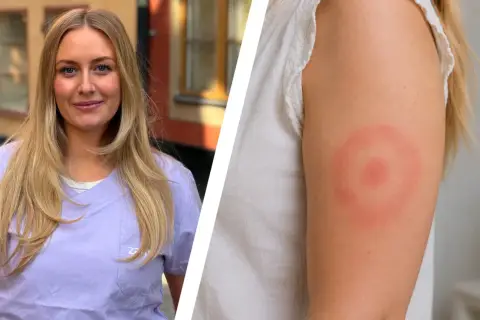 En kvinna med blont hår visar upp ett utslag på armen, ett tydligt tecken på borrelia.