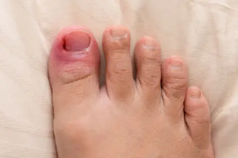 En inflammerad stortå med rodnad och svullnad runt nageln, vilket indikerar behov av nageltrång behandling.