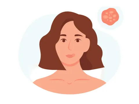 Genital herpes - symtom, smitta och vad som faktiskt hjälper