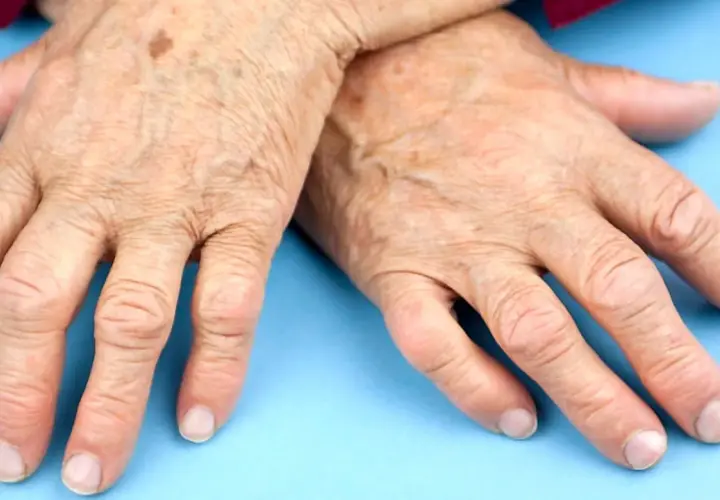 Äldre händer med synliga åderbråck och pigmentfläckar, som kan indikera behov av ny medicin mot reumatism.