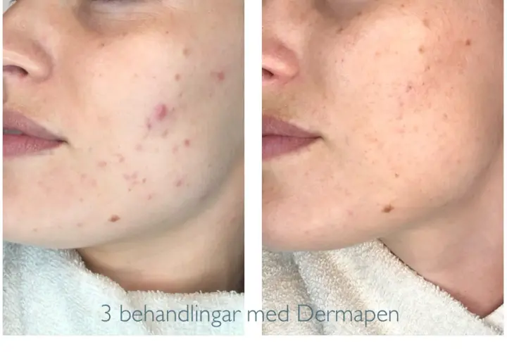 Före och efter-bilder visar hur Dermapen behandlat acneärr och förbättrat hudens textur.