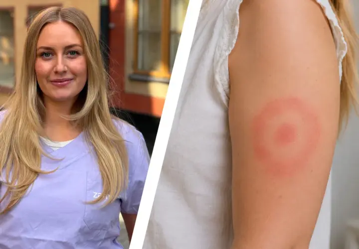 En kvinna med blont hår visar upp ett utslag på armen, ett tydligt tecken på borrelia.