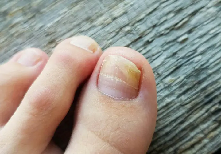 Tånagel med gulaktig missfärgning och förtjockning, tecken på nagelsvamp. Läs mer på 1177.