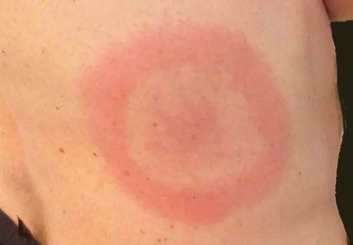 Rött, cirkulärt utslag på huden, liknande ett utslag i ansiktet som kan uppstå vid exempelvis borrelia.