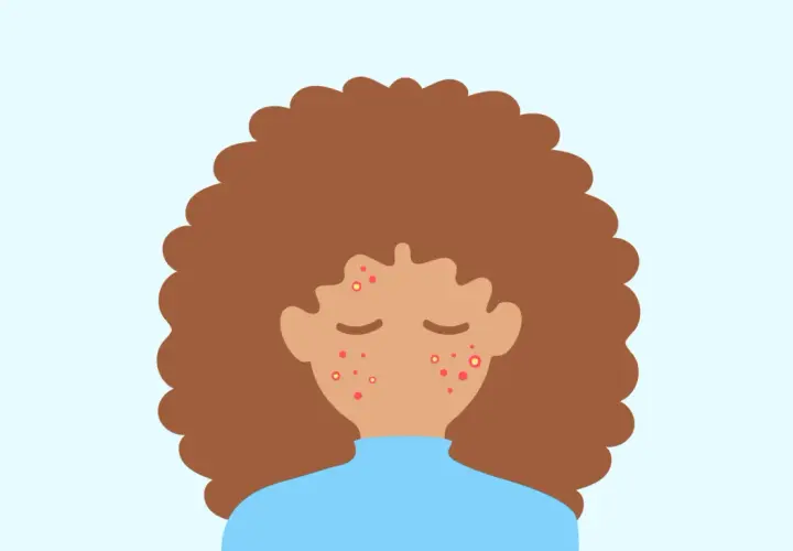 En illustration av en person med lockigt brunt hår och en blå tröja. Ansiktet har flera röda prickar, vilket indikerar finne under huden.