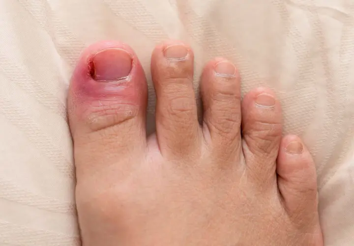 En inflammerad stortå med rodnad och svullnad runt nageln, vilket indikerar behov av nageltrång behandling.