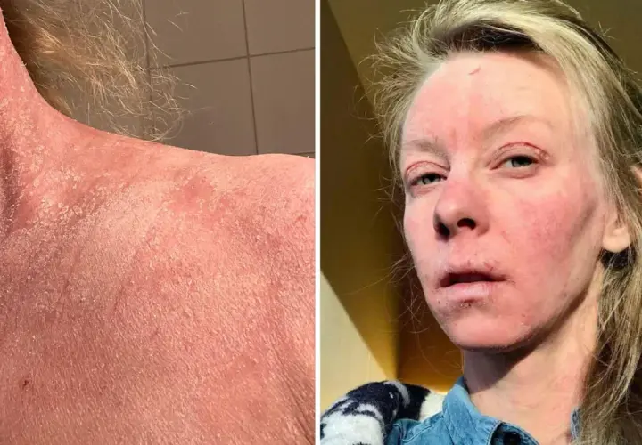 Bilden visar en person med svår hudirritation, fjällande hud på nacken och axlarna, samt rodnad och sår på ansiktet. Detta kan vara relaterat till användning av kortison och alkohol.