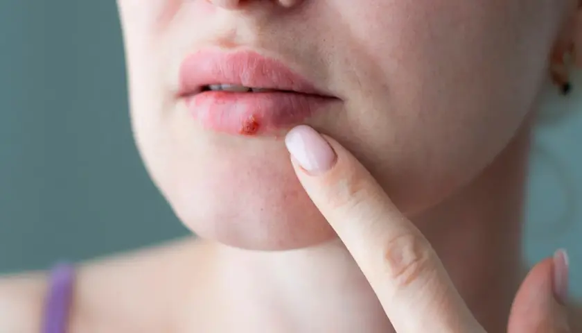 En person pekar på ett sår på läppen, troligen munherpes inne i munnen.