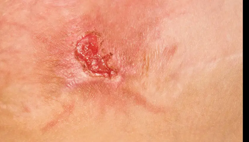 Närbild på en infekterad hudskada med rodnad och sårskorpa, potentiella mrsa symtom.