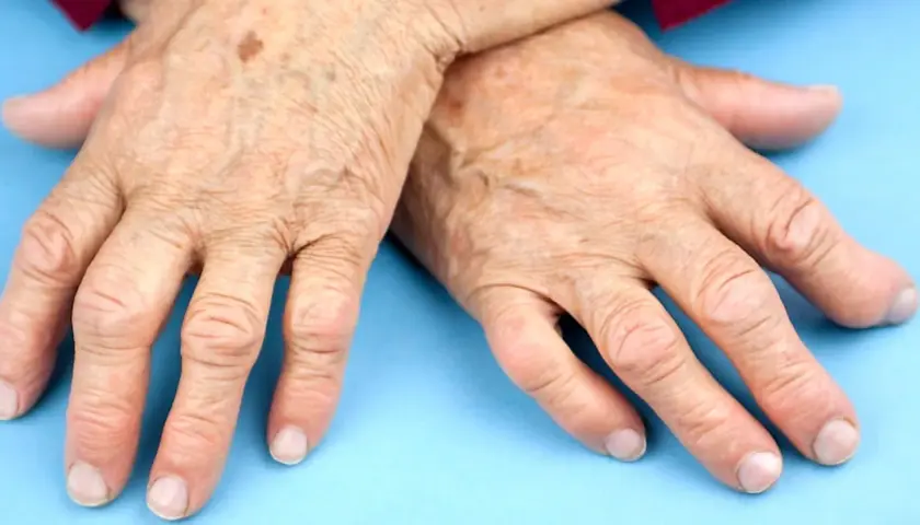 Äldre händer med synliga åderbråck och pigmentfläckar, som kan indikera behov av ny medicin mot reumatism.