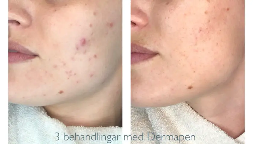 Före och efter-bilder visar hur Dermapen behandlat acneärr och förbättrat hudens textur.