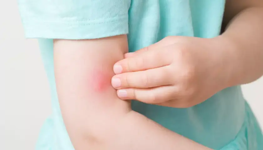 Barnets arm med ett rött, svullet myggbett. Barnet verkar vara allergisk mot myggbett och kliar på bettet.