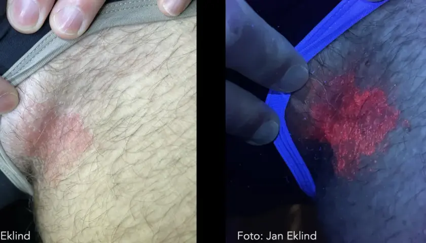 Hudutslag på ljumsken, synligt i vanligt ljus och under UV-ljus som visar en rödaktig svamp pung.