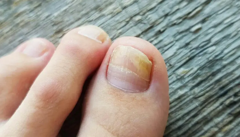 Tånagel med gulaktig missfärgning och förtjockning, tecken på nagelsvamp. Läs mer på 1177.
