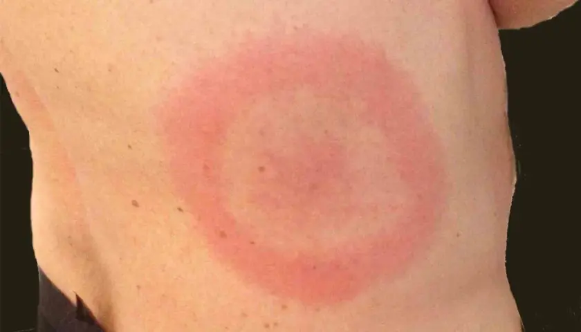 Rött, cirkulärt utslag på huden, liknande ett utslag i ansiktet som kan uppstå vid exempelvis borrelia.
