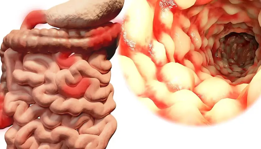 Illustration av inflammerade tarmar, som visar symtom på crohns sjukdom. En inre vy av tarmen visar rodnad och svullnad.
