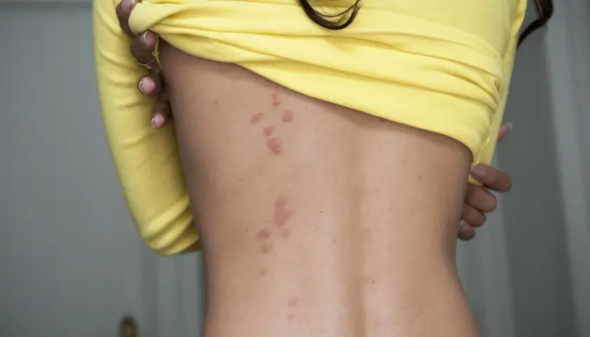 Röda utslag på ryggen, troligen från bed bugs svenska.