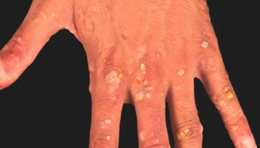 Hand med utslag av epidermodysplasia verruciformis. Många små, ljusa och mörkare fläckar samt knottror på fingrar och handrygg.