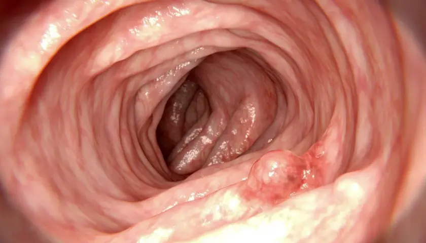 Insidan av tarmen visar veck och en utväxt, en polyp.