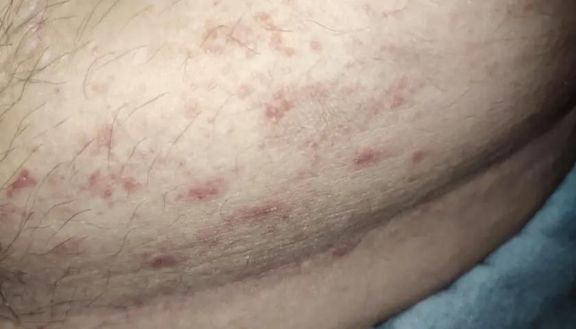 Hud med små röda prickar och utslag, möjligen relaterat till hiv.