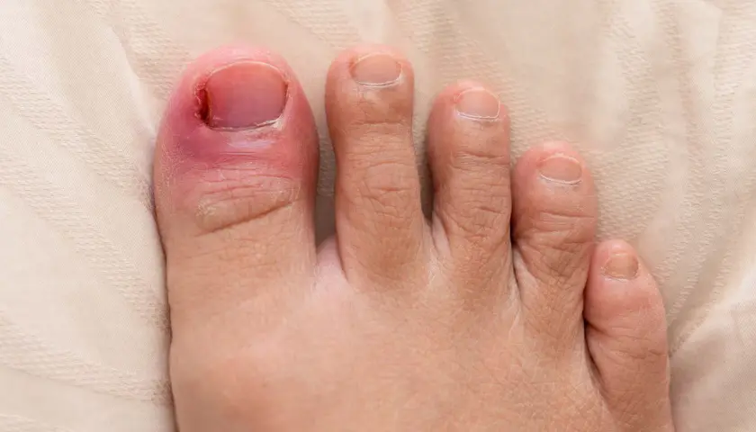 En inflammerad stortå med rodnad och svullnad runt nageln, vilket indikerar behov av nageltrång behandling.