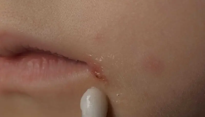 Närbild på ett litet sår vid munnen, kanske en svamp i ansiktet, som behandlas med en tops.