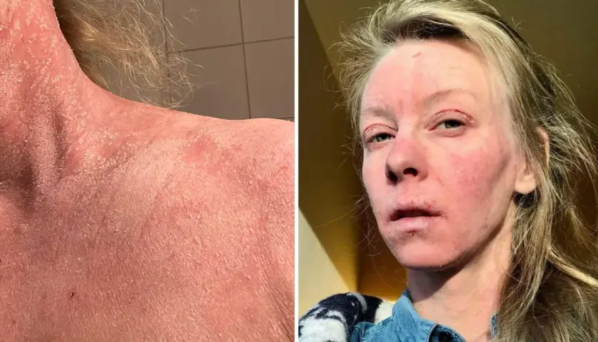 Bilden visar en person med svår hudirritation, fjällande hud på nacken och axlarna, samt rodnad och sår på ansiktet. Detta kan vara relaterat till användning av kortison och alkohol.