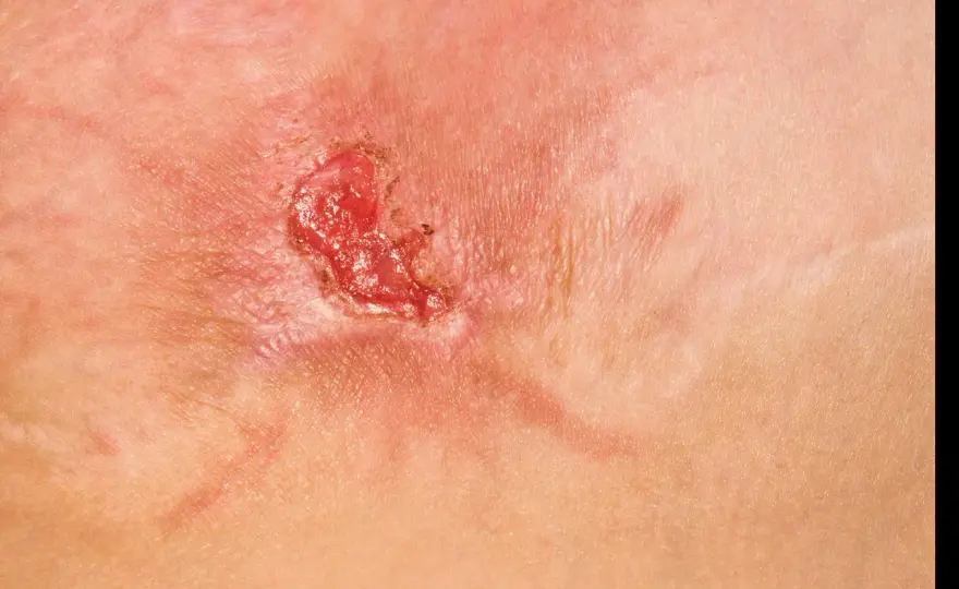 MRSA-symtom - så ser du tecknen och när du ska söka vård