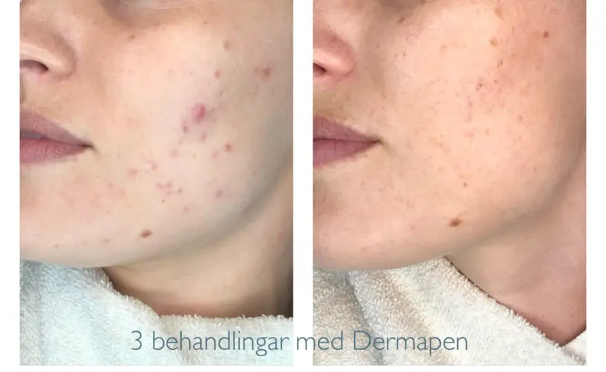 Dermapen mot acneärr - vilka ärr fungerar bäst?